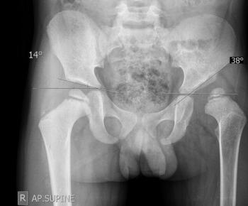 Patient B: Left acetabular index is increased (38 degrees while right is normal (14 degrees).