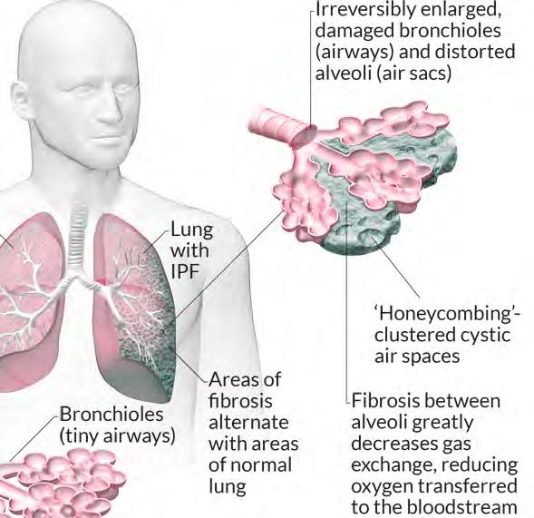 Interstitial lung disease ILD occurs when the body s repair system