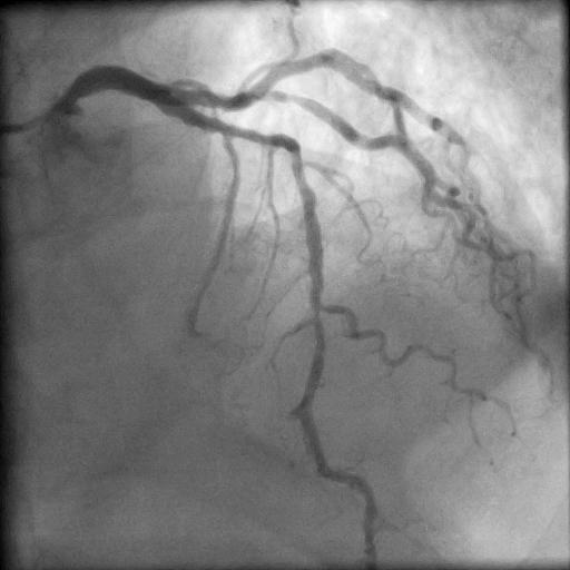 Diffuse disease Functional significance? Focal segments, PCI?