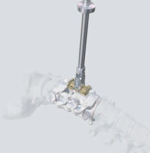 5 Implantation Insert ECD into the resected part of the spinal column and align it in the sagittal and frontal plane.