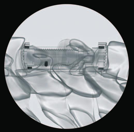 2 Note: As soon as the implant endplates touch the vertebral endplates push the instrument slightly caudally in order to guarantee an optimal function of the expansion mechanism.