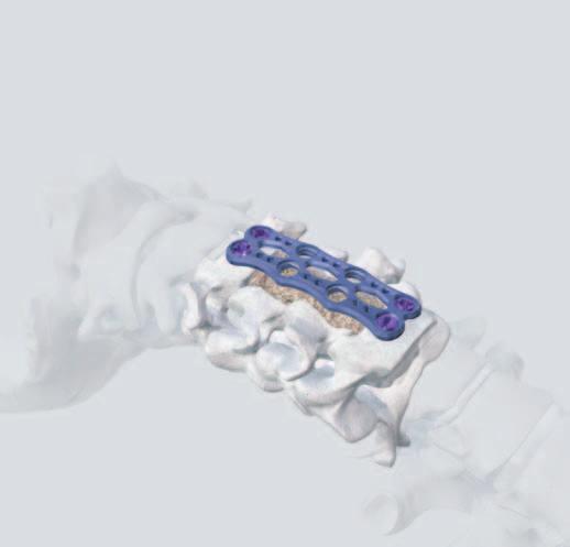 8 Add bone chips or chronos Fill the area around the ECD, especially the anterior part, with bone chips or chronos*. * See brochure chronos in Spine Surgery (036.000.020).