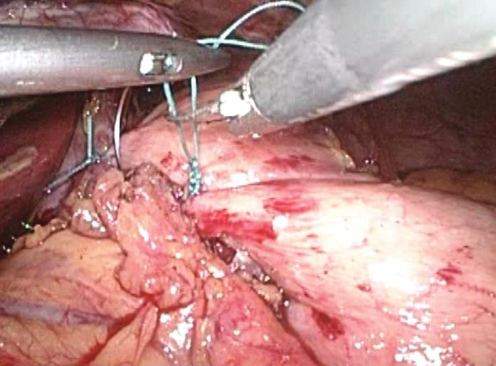 Laparoscopic Myotomy: Surgical Technique The patient is placed on the operating table in the supine position, and pneumoperitoneum is established followed by placement of 3 to 4 additional trocars