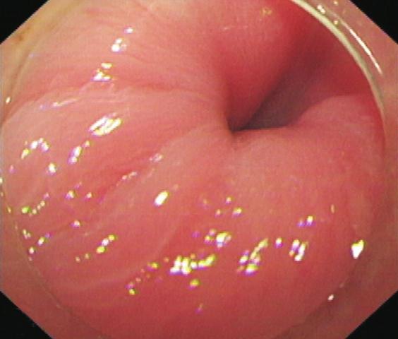 (B) Submucosal injection in the 5- to 6-o clock position using a water jet-assisted hybrid knife. (C) Mucosal incision on the posterior wall.