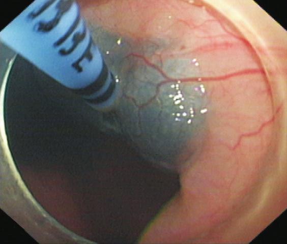 (H) Substantial reduction of lower esophageal sphincter tone after POEM.