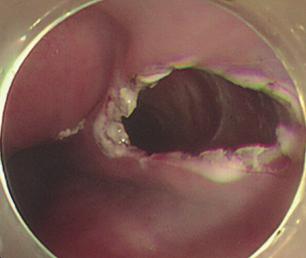 Lee BH et al. A B C D E Fig. 2. (A) A 2-cm longitudinal incision was performed on the mucosal surface for initiation of an entry point into the submucosal space.