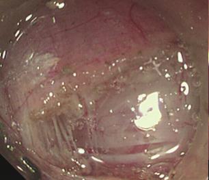 (C) Endoscopic myotomy was begun 2 cm distal to the mucosal entry using Dual Knife and Hook Knife.