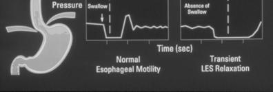 Defective Esophageal Clearance Ineffective peristalsis