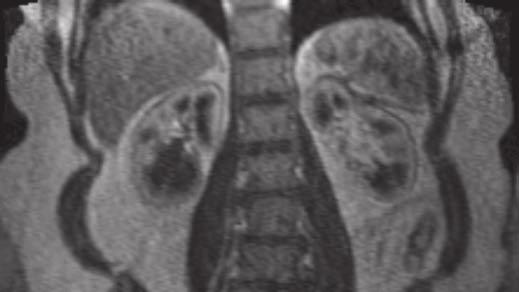 requiring repair. Acute tubular necrosis developed postoperatively.