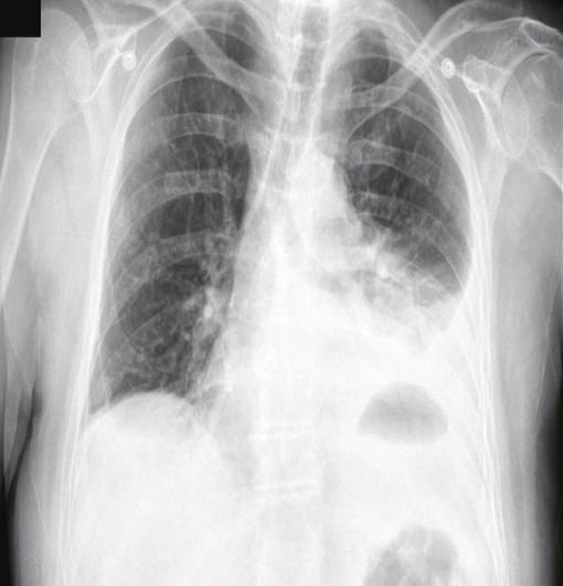 2 Case Reports in Surgery Figure 3: CXR Case 2; AP and lateral CXR demonstrating an airfluid level in the posterior left hemithorax.