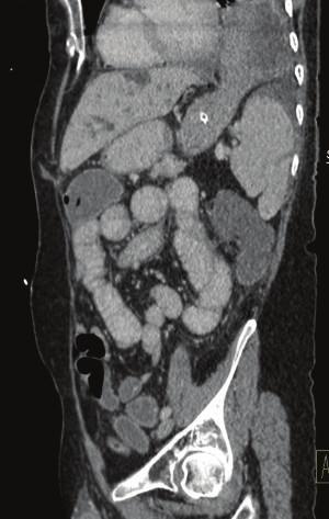 Figure 4: CT Case 2; coronal section demonstrating herniation of the gastric fundus through a diaphragmatic defect-note (as indicated by arrow) air-fluid level in herniated fundus indicating