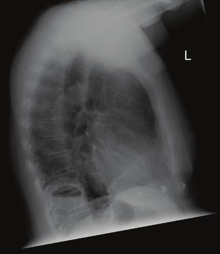 Figure 2: CT Case 1; saggittal section showing herniation of the gastric fundus through a diaphragmatic defect (as indicated by arrow) with evidence of incarceration-note nasogastric decompression of