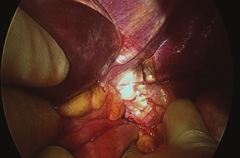 Case Reports in Surgery 3 Figure 5: Operative photograph Case 2; herniation of the stomach through a diaphragmatic defect visualised at laparotomy. 4.