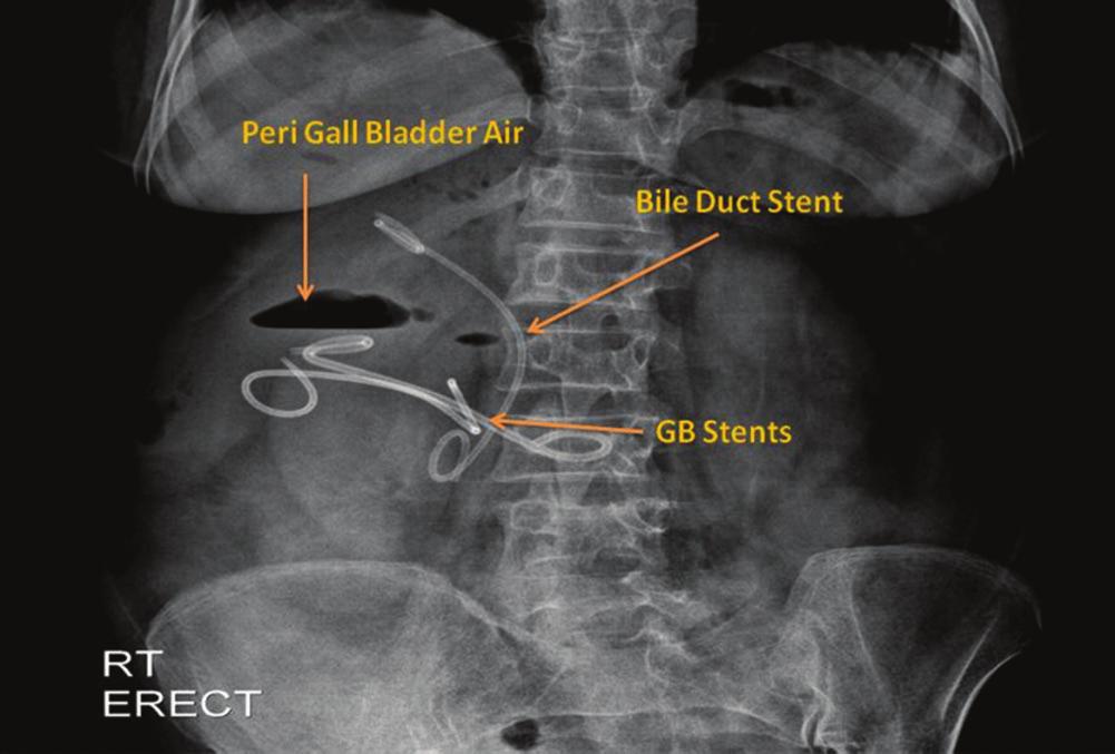 Fluoroscopy image made during the procedure and showing the dilatation of the tract using a controlled radio expansion balloon over a radio opaque guidewire placed in the gall bladder.