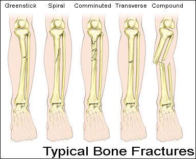 Bone Fractures Occur less often in youth, requires exceptional trauma twists or smashes Two types simple or compound