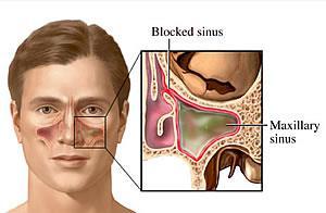 Sinuses Air cavities Paranasal Open into nasal cavities Lined with