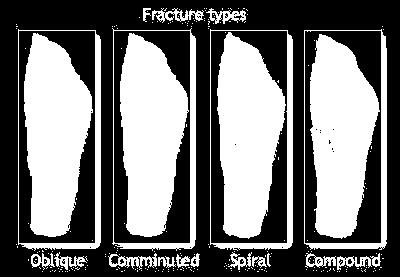 (compound) fracture broken bone penetrates through the skin Bone