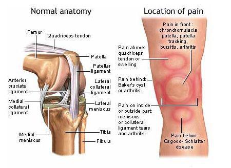 Inflammatory Conditions Associated with Joints Bursitis inflammation of a bursa usually caused by a blow or friction Tendonitis inflammation of