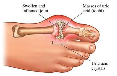 Clinical Forms of Arthritis Gouty Arthritis Inflammation of joints is caused by