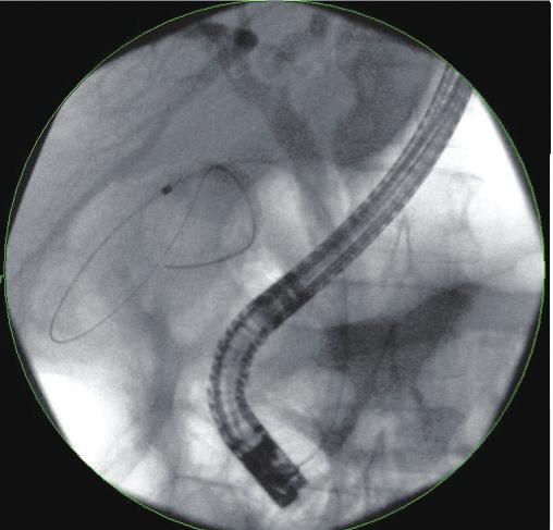 Deployment of a 7 Fr 15 cm double pigtail plastic stent (Boston Scientific) into the gallbladder from the transpapillary position. Fig. 3.
