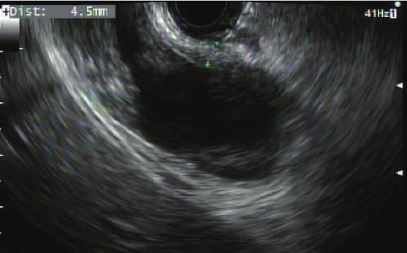 Fig. 6. Endosonographic view of the gallbladder with a thickened wall measuring 4.5 mm. Fig. 9. Passage of a 0.