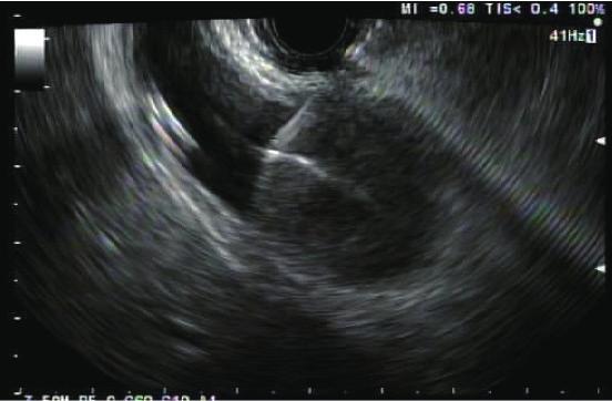 Endosonographic view of a gallbladder that has been punctured with a 19 G endoscopic ultrasound-guided aspiration needle (Cook Endoscopy). Fig. 10.