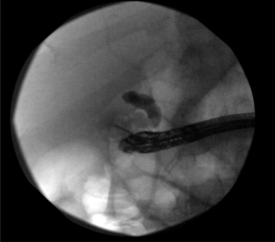 cm fully covered metal stent (GORE VIABIL; Gore Medical) into the gallbladder from the transduodenal position. Fig. 8.