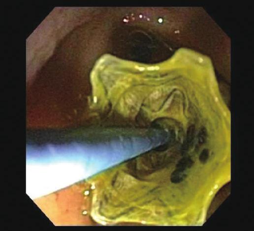 Widmer J et al. EUSGLB for Cholecystitis RESULTS Fig. 11. Deployment of 7 Fr 15 cm double pigtail plastic biliary stent (Boston Scientific) through the metal stent into the gallbladder.