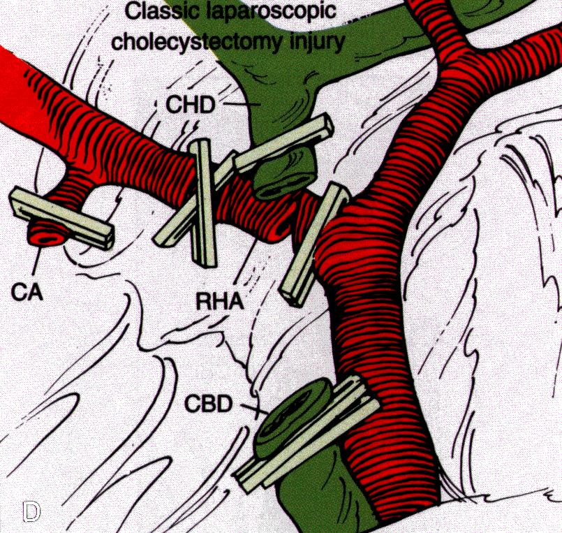 Reasons to Convert Acute cholecystitis Contracted gallbladder Impacted stone in CD/HP Biliaryenteric fistula Cirrhosis Intrahepatic gallbladder Respiratory acidosis Very large gall stones Aberrant