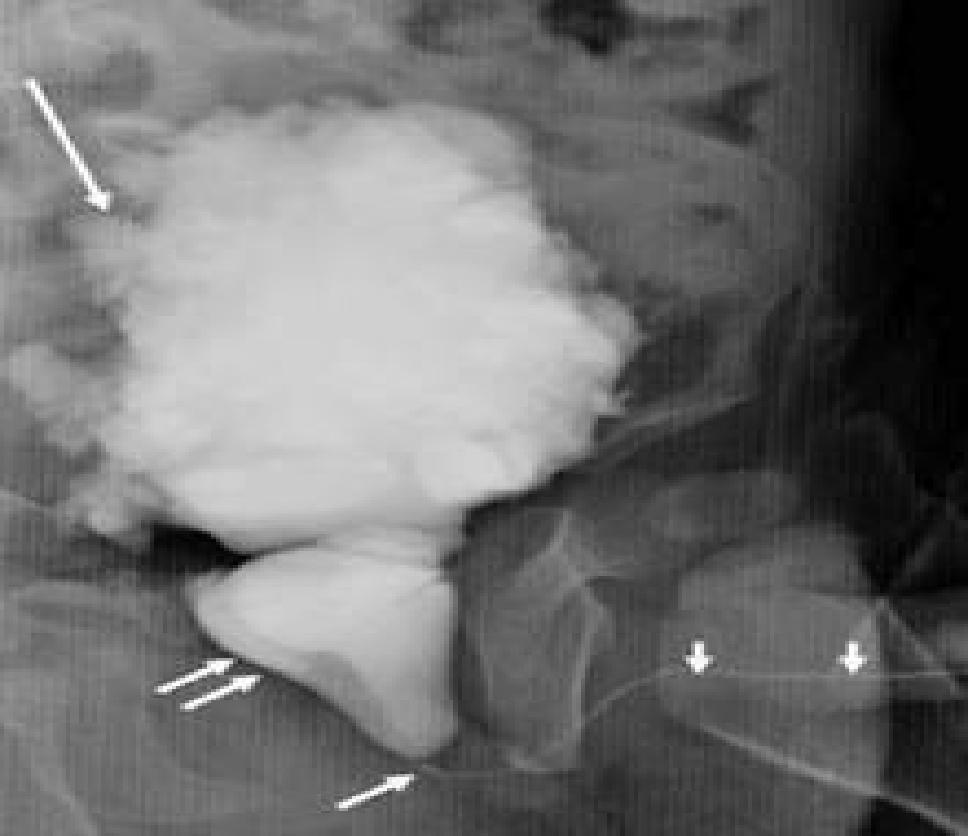 In cases with moderate to severe obstruction, there will be associated bladder wall thickening, trabeculation and diverticulae with a dilated cone shaped posterior