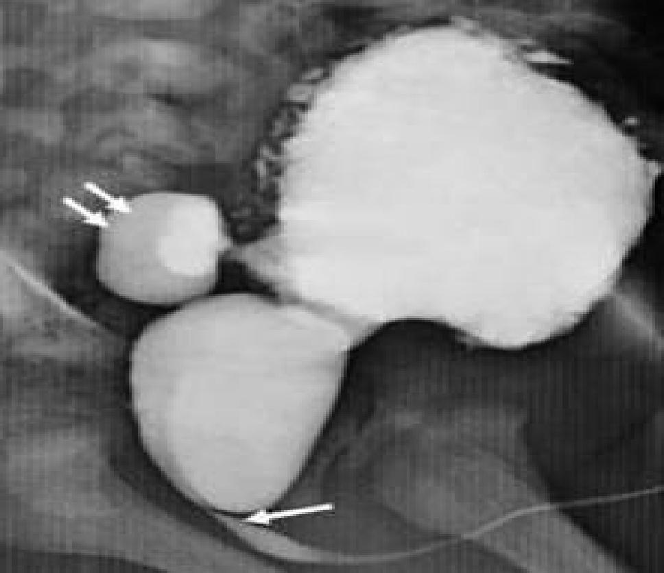 Under filled anterior urethra seen (short arrows) with secondary pressure changes in the urinary bladder(long arrow).