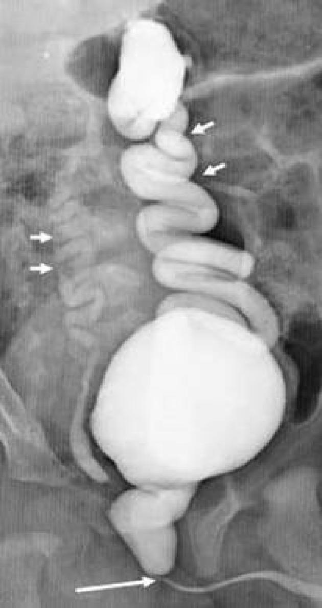 4 Vesicoureteral reflux may be present in 50% of male patients with posterior urethral valves.