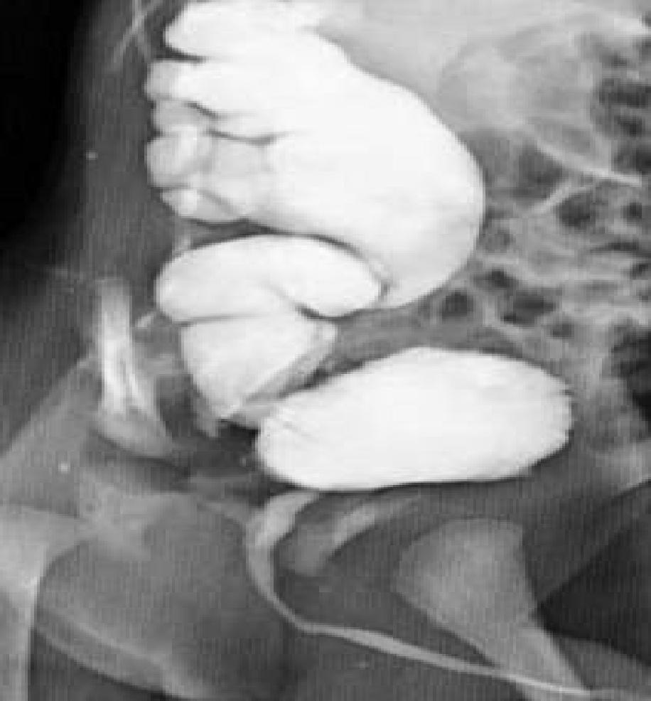 Contrast is seen the abdominal cavity (long arrows).posterior urethral valve is seen (short arrow).