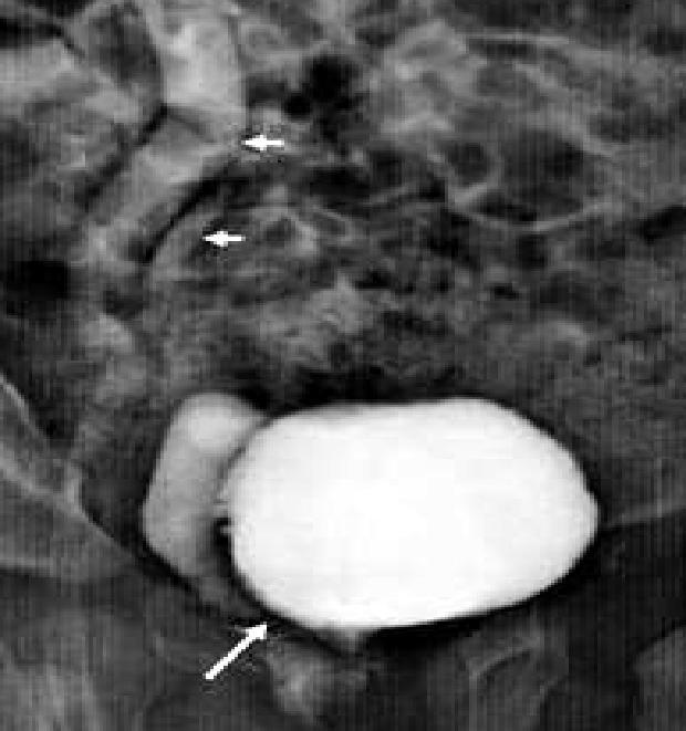 In cases of chronic cystitis low bladder capacity with scarring, can be well demonstrated on MCUG (Fig. 14). Figure 15: Left ureterocele.
