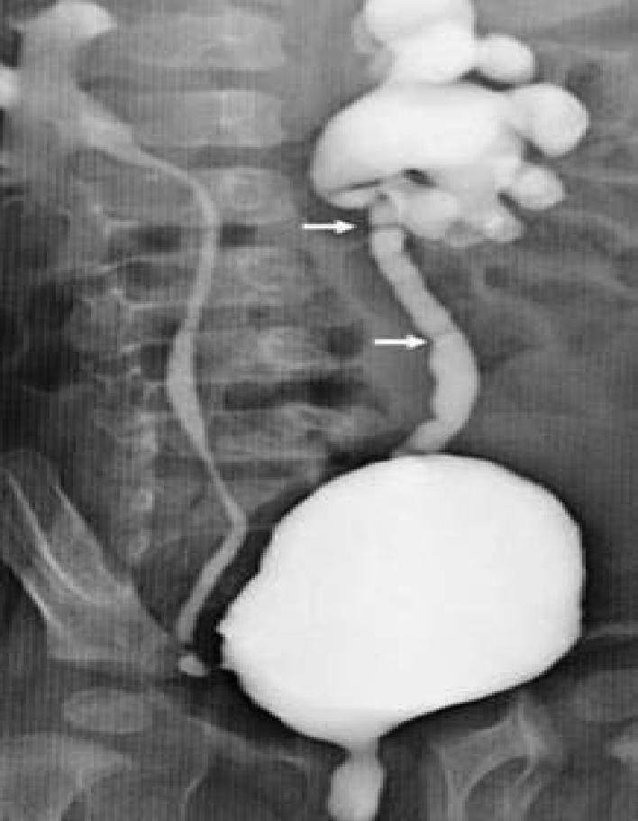 Ureteral valves are rare and are usually unilateral.