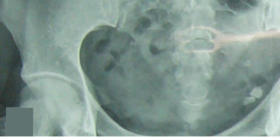 the region of pelvis; (d) CECT image of Case 4 showing focal contrast enhancement in the nodule in pelvis.