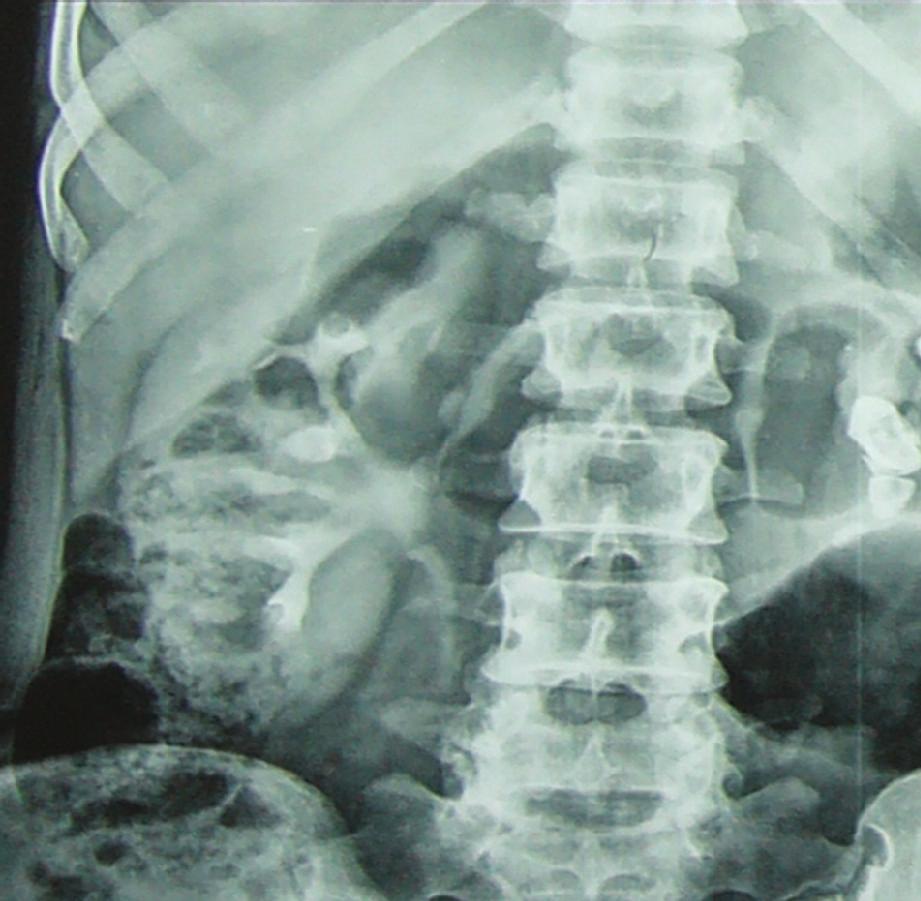 No corticomedullary distinction was identified. The renal pelvis appeared pale and diﬀusely thickened.