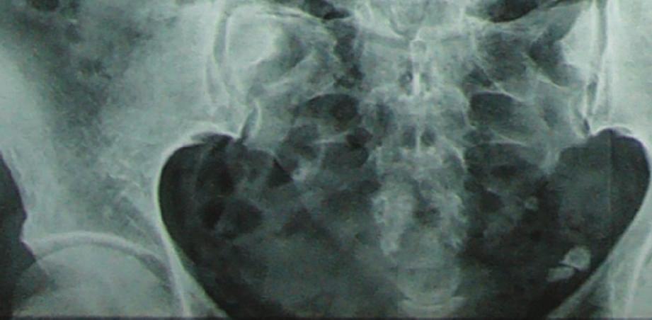 The patient had an uneventful postoperative course but was lost to follow up after discharge from the hospital before his metastatic workup could be performed. Case 2.