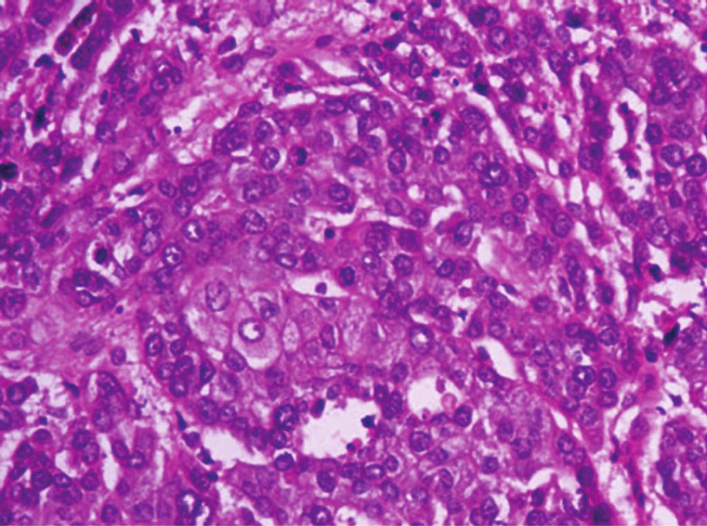 The tumor is comprised predominantly of undiﬀerentiated malignant tumor cells with islands of clearly squamous cells interspersed without keratinisation as seen in
