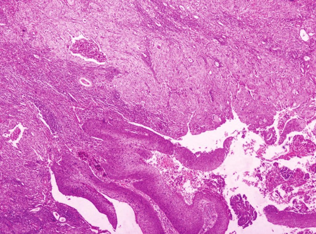 The urothelium lining the pelvis shows squamous metaplasia and dysplasia; (d) the same case showing tumor cells forming true papillae with fibrovascular cores seen in