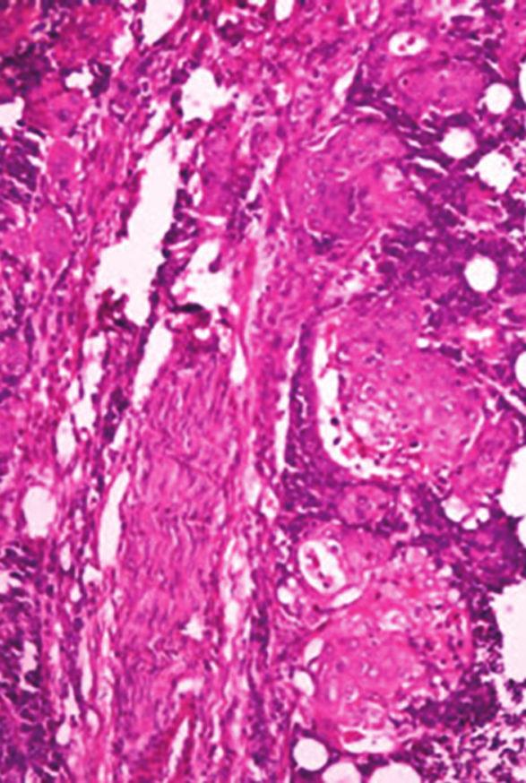 5%), and one case each of chromophobe renal cell carcinoma, one case of collecting duct carcinoma, one case of Wilm s tumor, and one case of transitional cell
