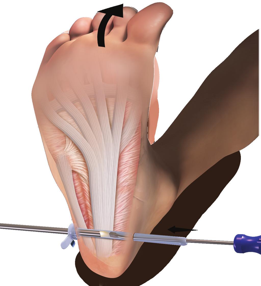 9 10 The soft tissue rasp is introduced into the medial portal and used to remove any remaining soft tissue from the field.
