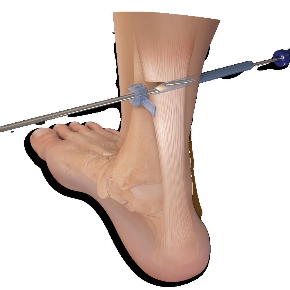 Endoscopic Gastroc Recession Arthrex has developed a comprehensive, completely disposable system for endoscopic gastrocnemius recession.