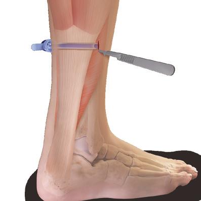 Relax the dorsiflexion force from the surgeon s body while