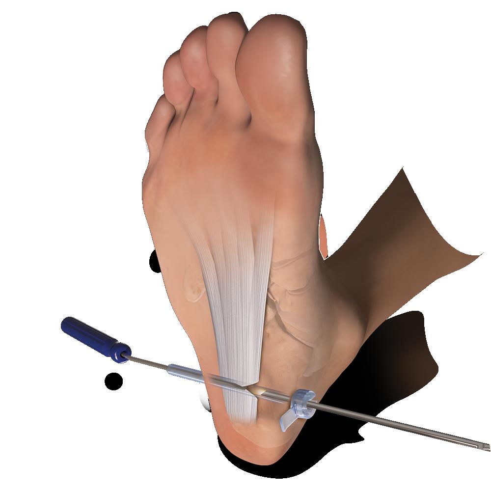 Endoscopic Plantar Fascia Release Arthrex has also developed a comprehensive, completely disposable system for