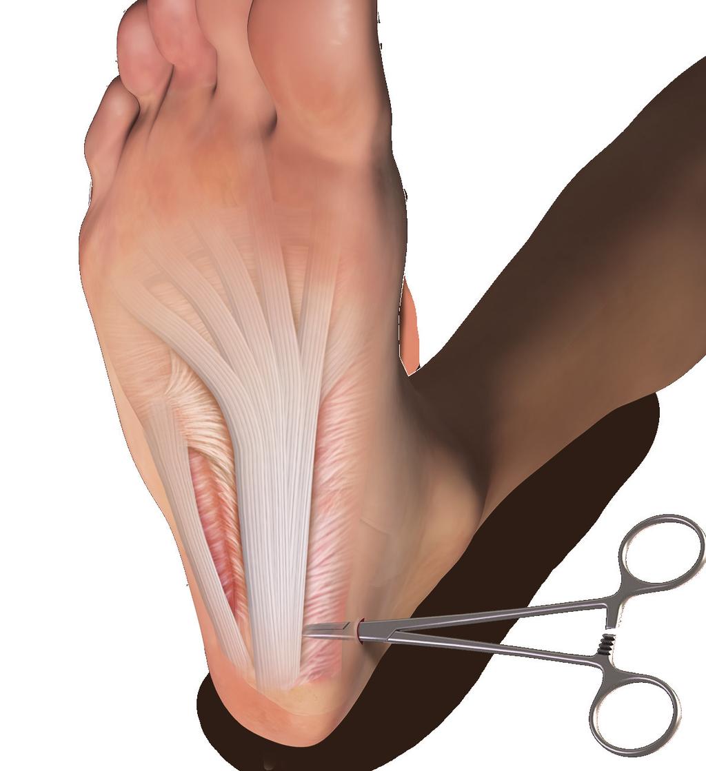 This medial portal is typically aligned with the posterior border of the distal tibia.