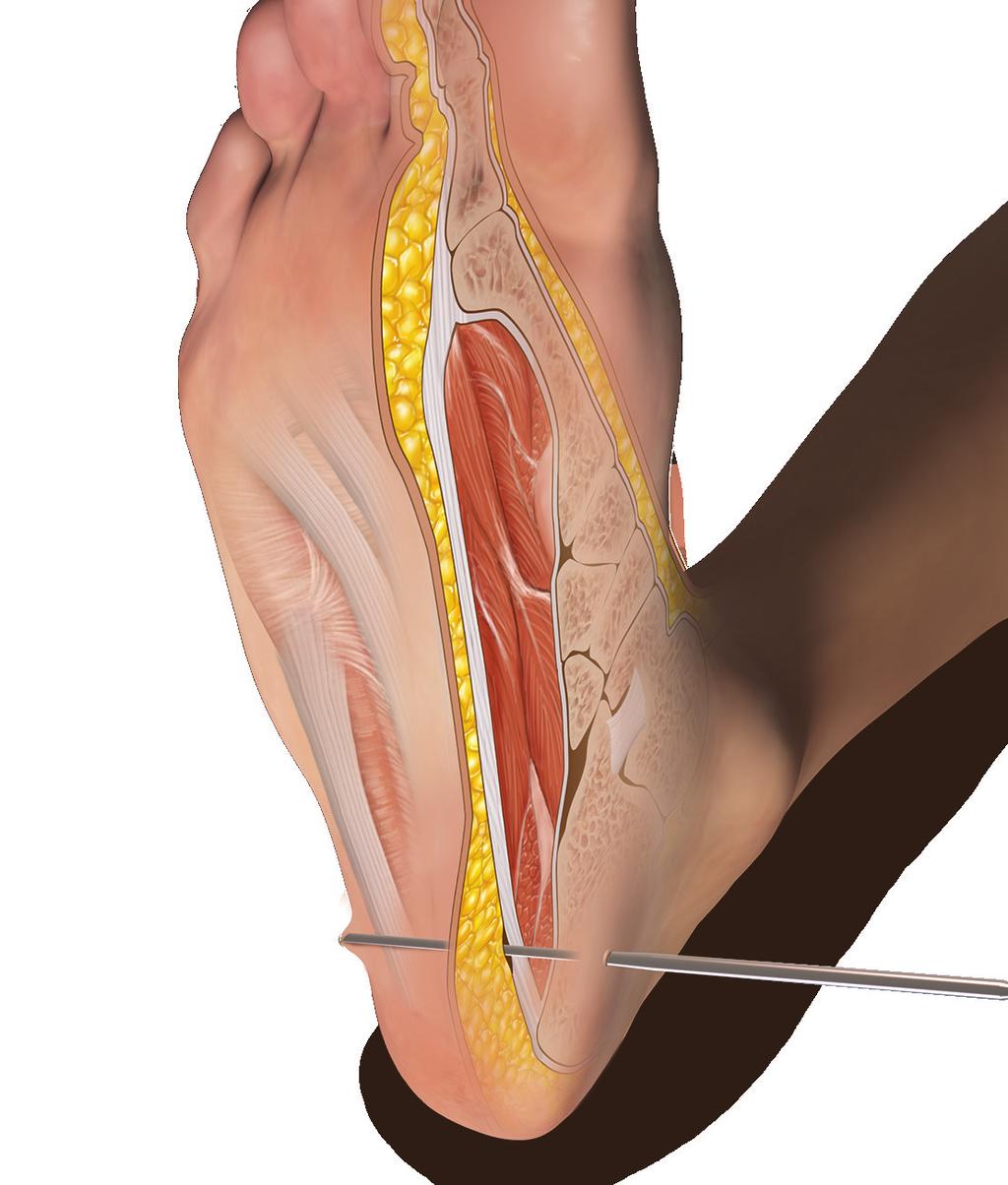 inferior to the plantar fascia. 2 A blunt instrument such as a hemostat, is inserted to correctly identify the proper plane.