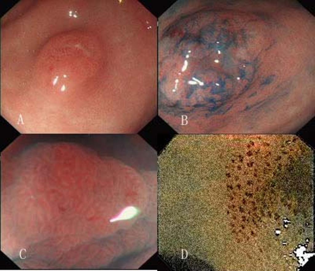 Page 3 of 7 Figure 1 Demonstration of gastric precancerous lesion with conventional endoscopy(a) and iodine staining pattern (B); Pit pattern of this precancerous lesion with magnifying