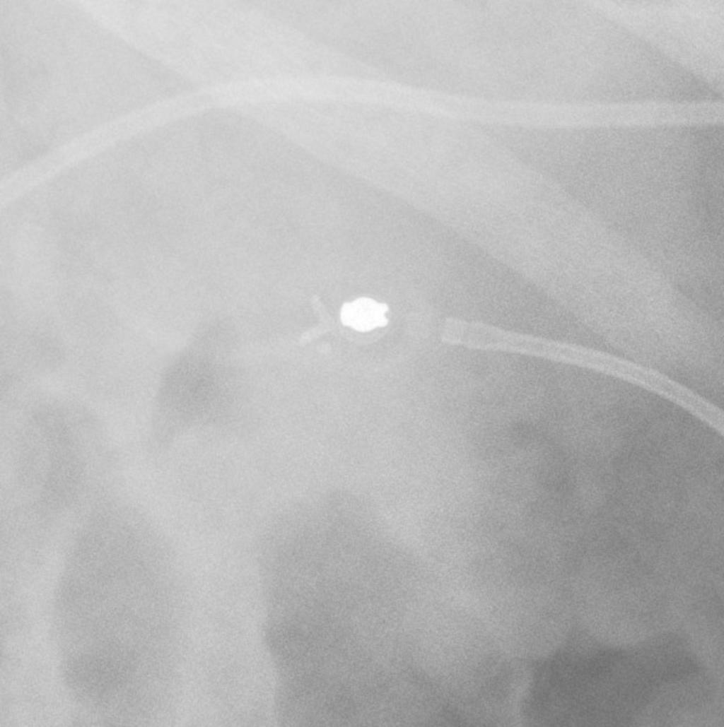 Fig. 6: Plain Film appearance of the Strata Valve used in lumbar peritoneal shunt.