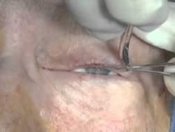 in technique between the upper & lower eyelids, canthi, and periorbital skin *RFS: